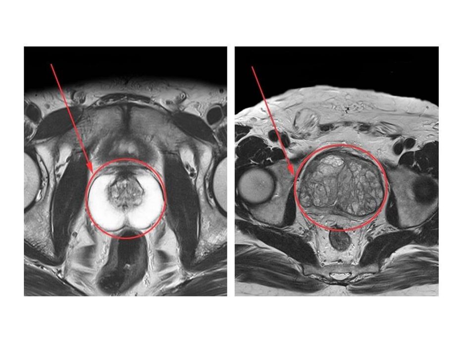Comparison of healthy (left) and inflamed (right) prostate on MRI image
